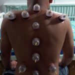 Cupping Therapy